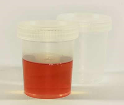 Hematuria (Blood in the Urine) - Urology Clinic in Malaysia