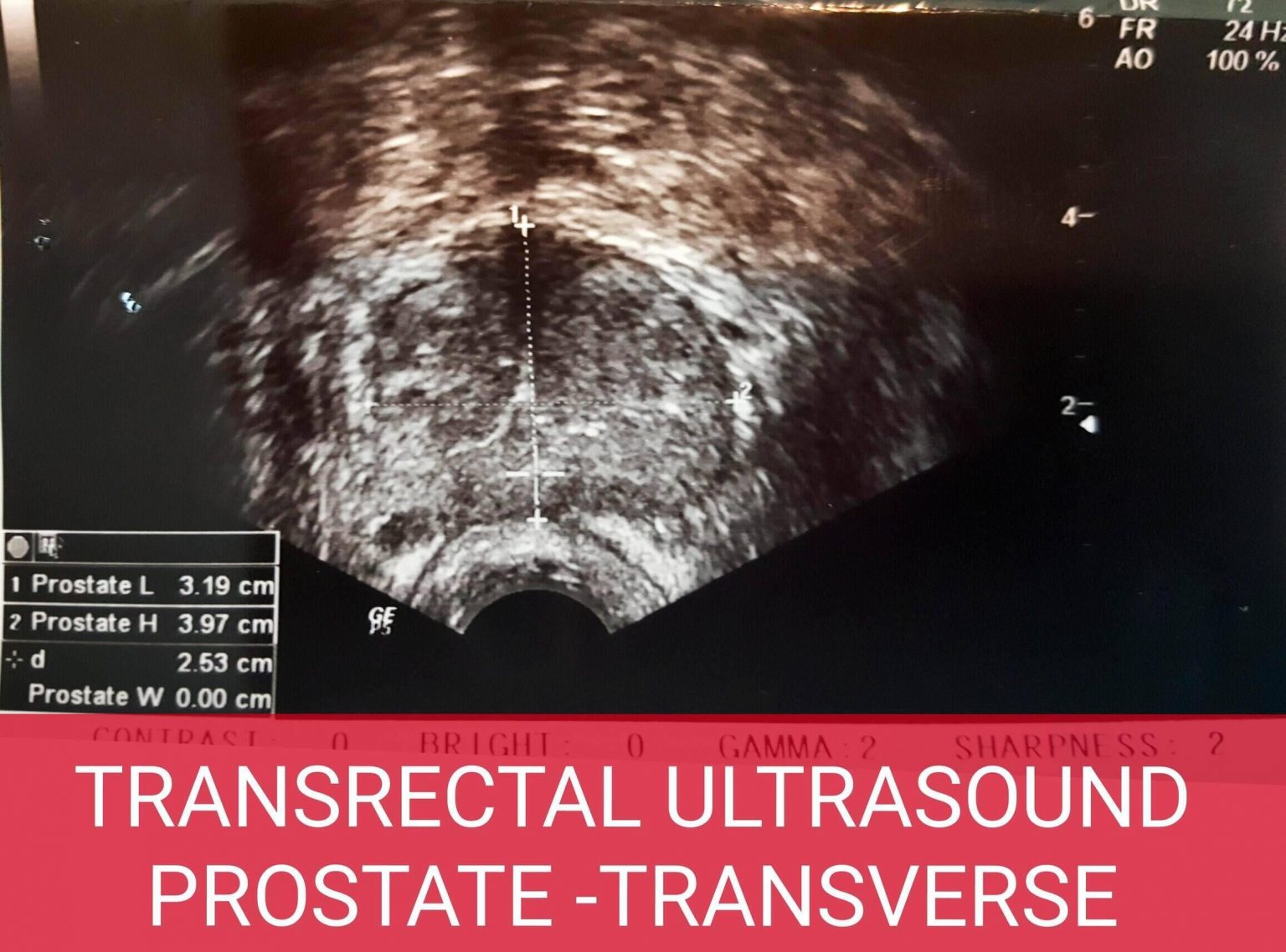 Transrectal Ultrasonography Of The Prostate Urology Malaysia 4521