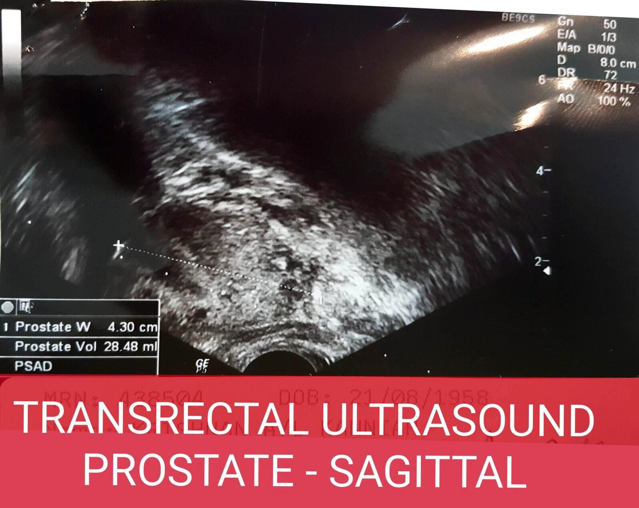 Transrectal Ultrasonography Of The Prostate Urology Malaysia