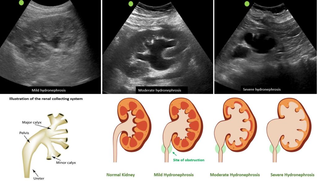 Hydronephrosis (swelling Of The Kidneys) - Urology Malaysia