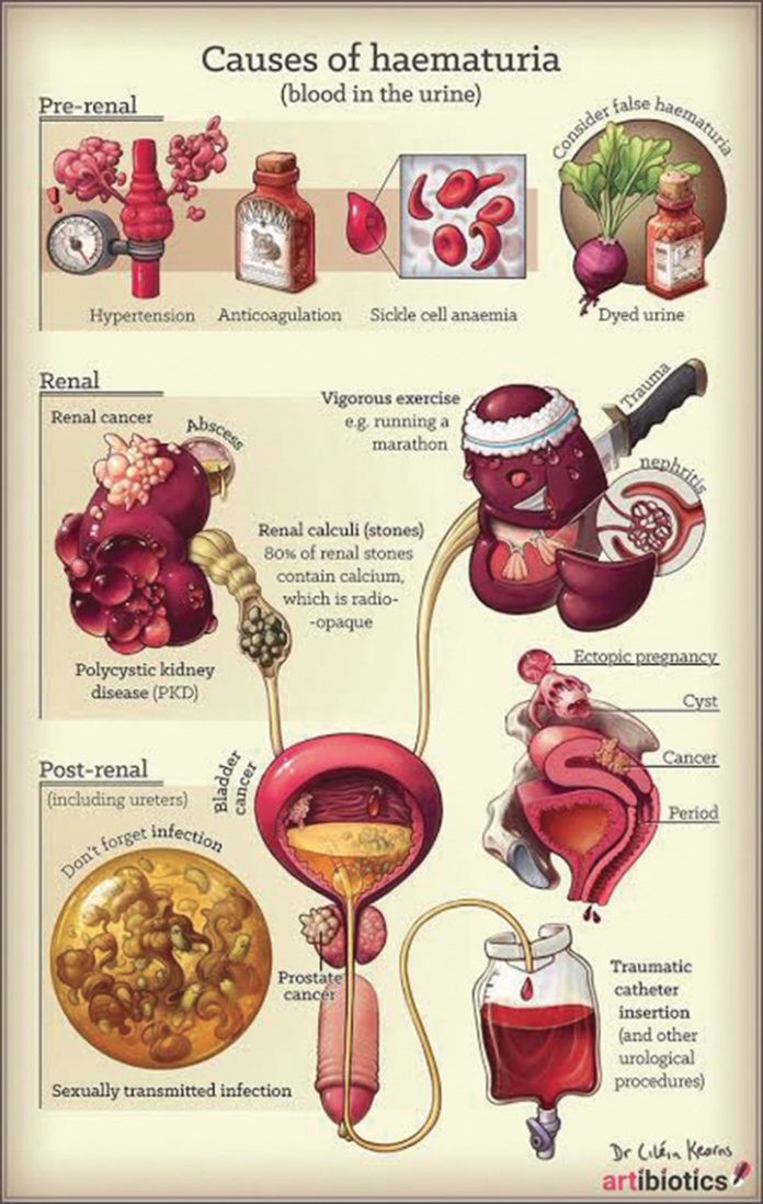 Hematuria (Blood In The Urine) - Urology Clinic In Malaysia