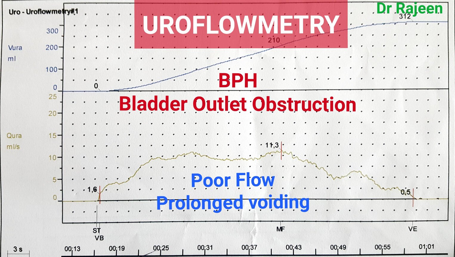 Uroflowmetry - Urology Clinic In Selangor Malaysia